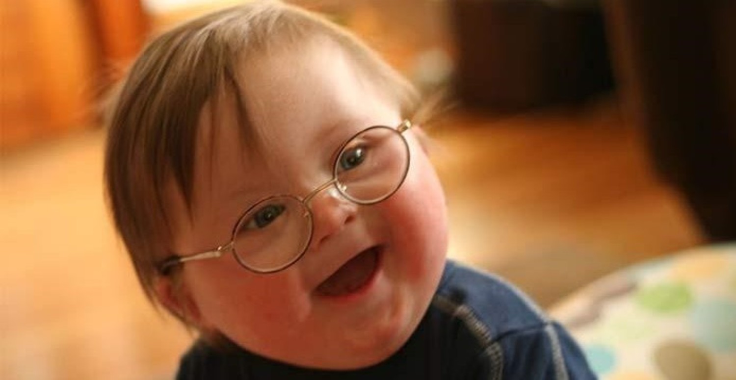 prader-will sendromu belirtileri