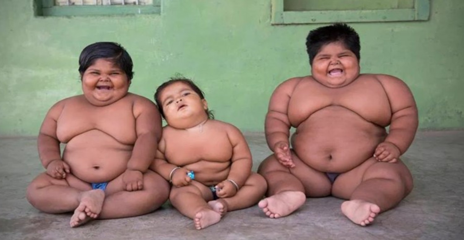 prader-will sendromu obezite