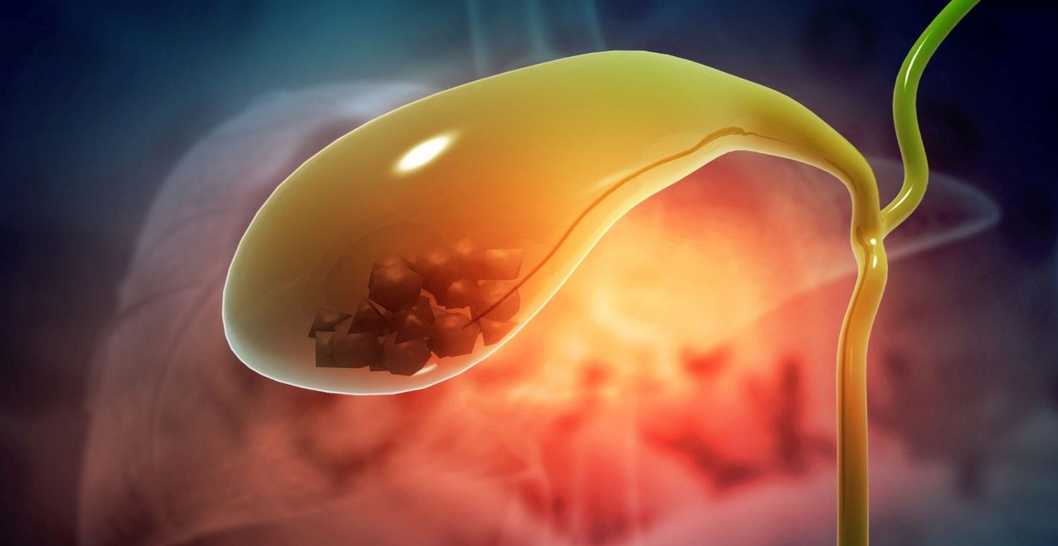 SAFRA TAŞI TEŞHİSİ