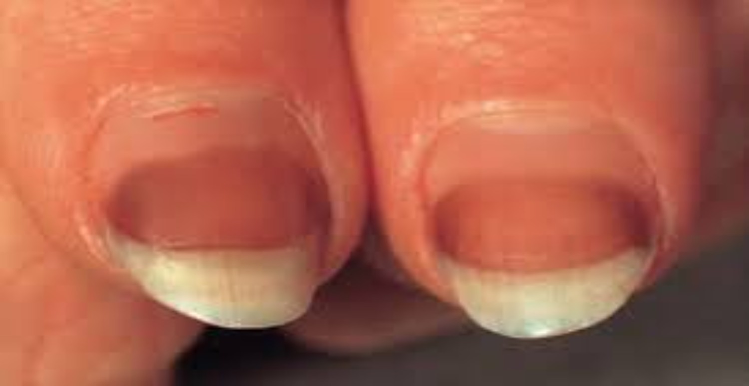 TIRNAK RENK DEĞİŞİMİ