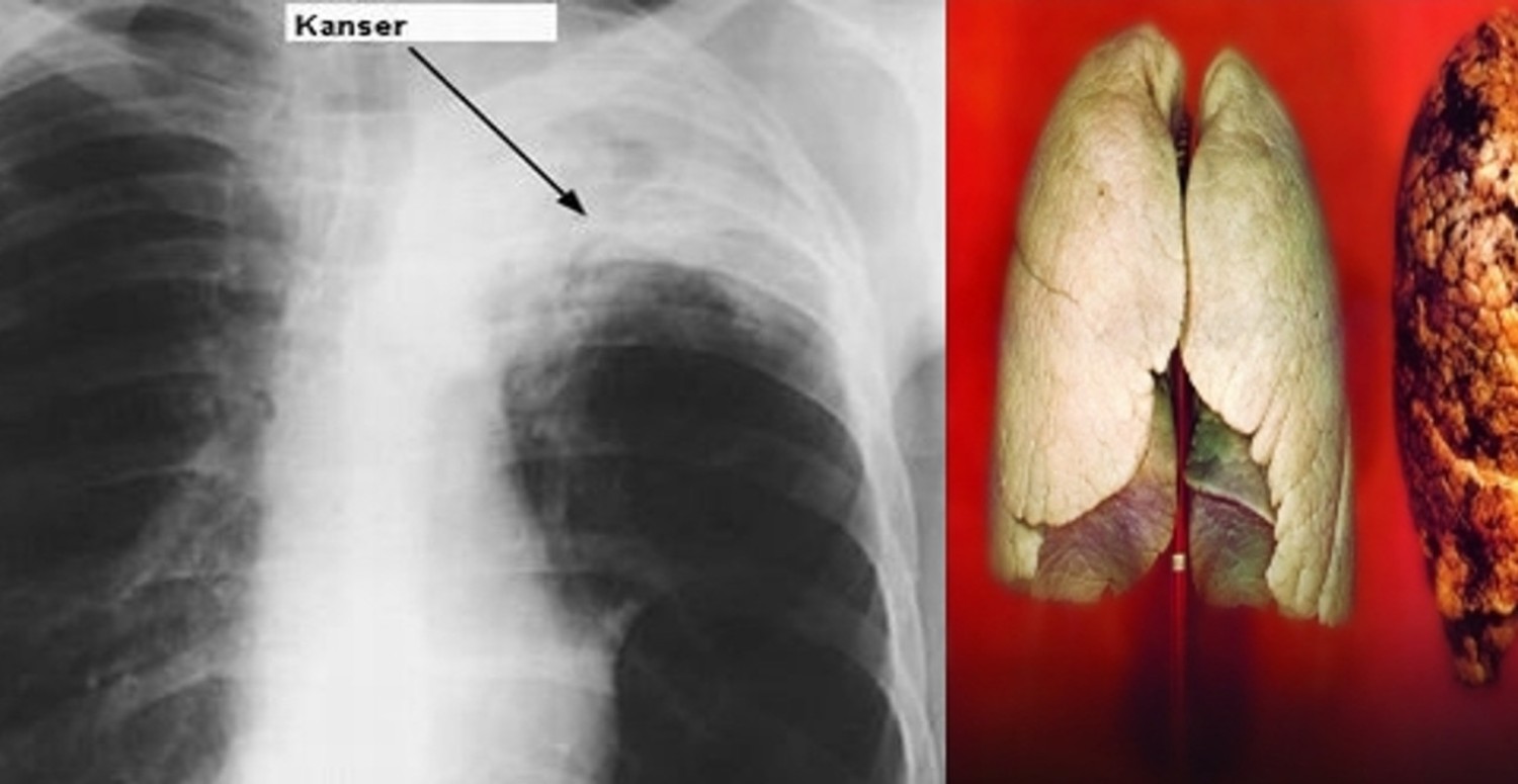 AKCİĞER KANSER BELİRTİSİ