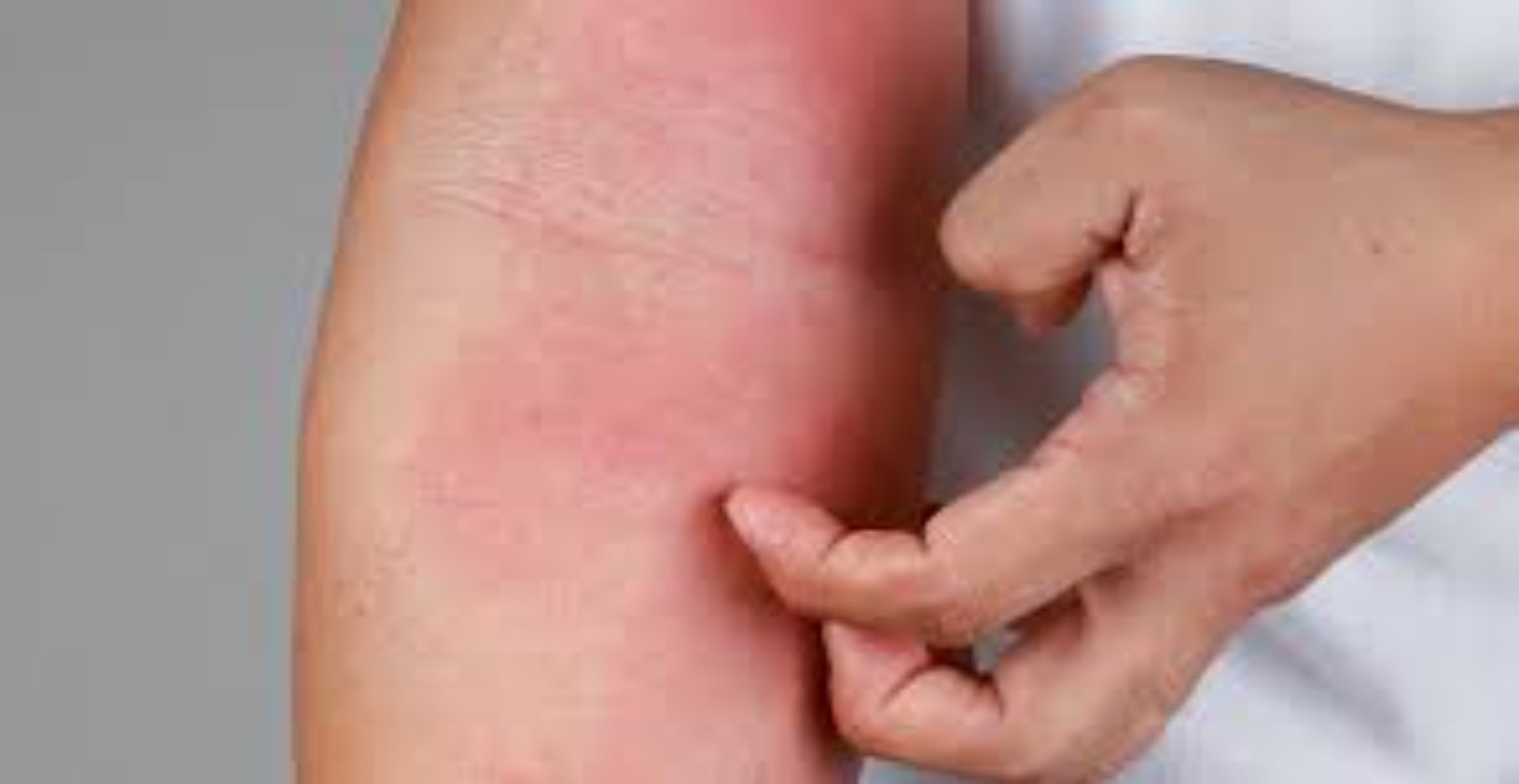 ciltte kızarıklık