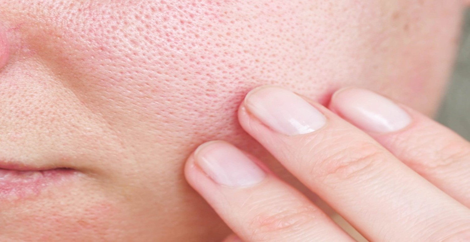 gözeneklerin kapanması