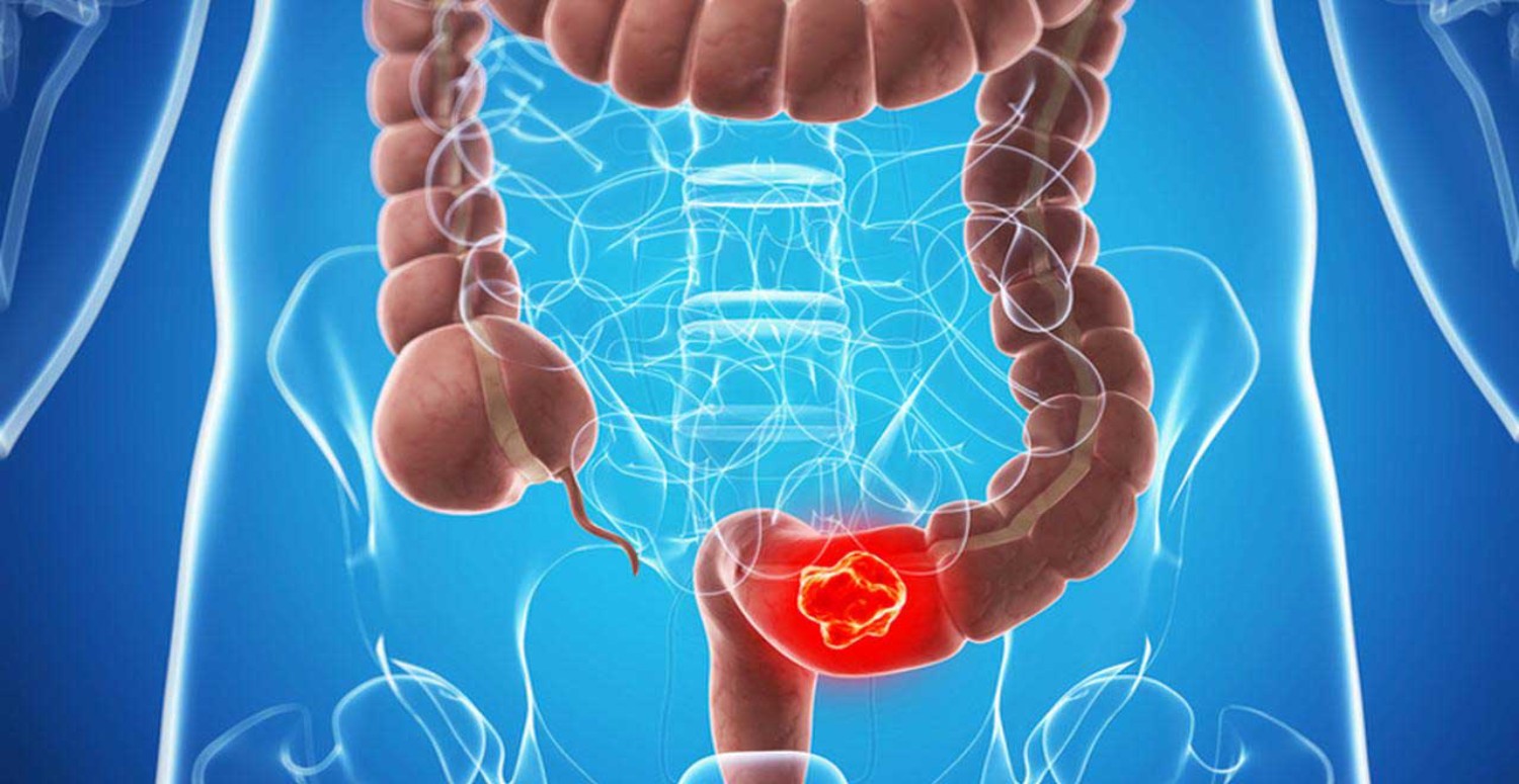 kolon kanseri özellikleri