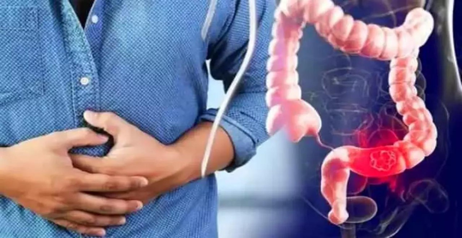 kolon kanseri tedavisi