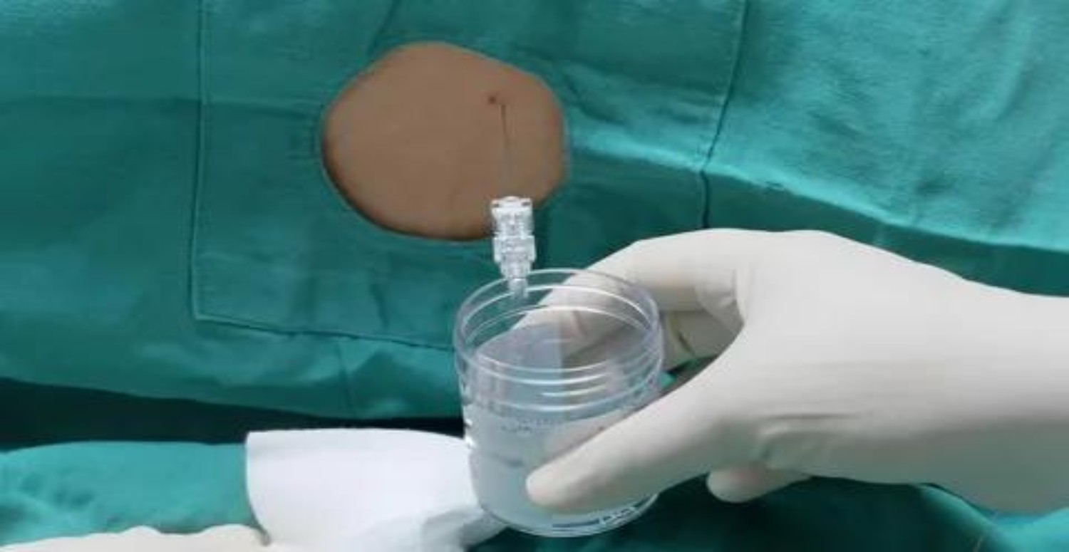 ORGAN NAKLİ HAKKINDA