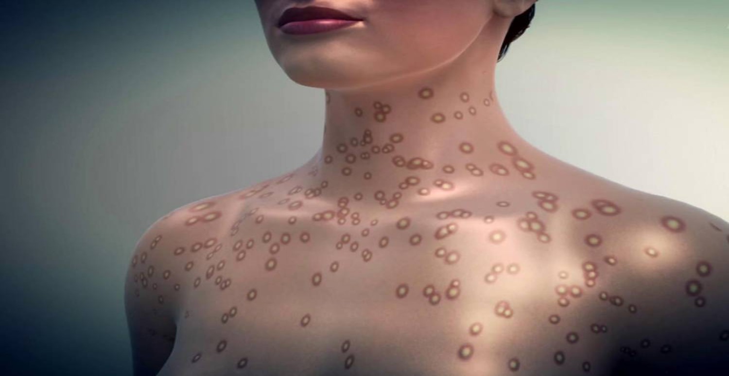 porfiriya hastalığı