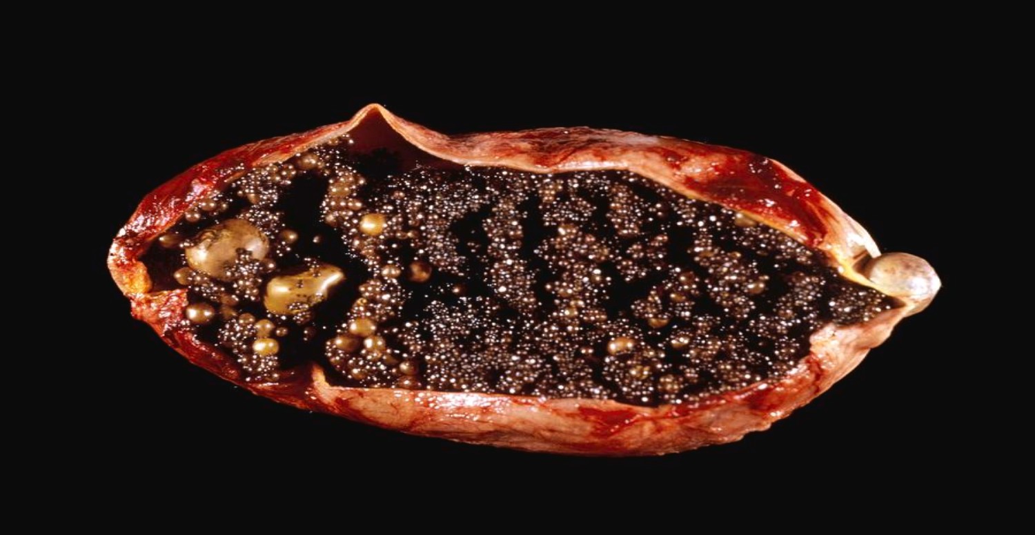 safra kesesi taşları neden olur