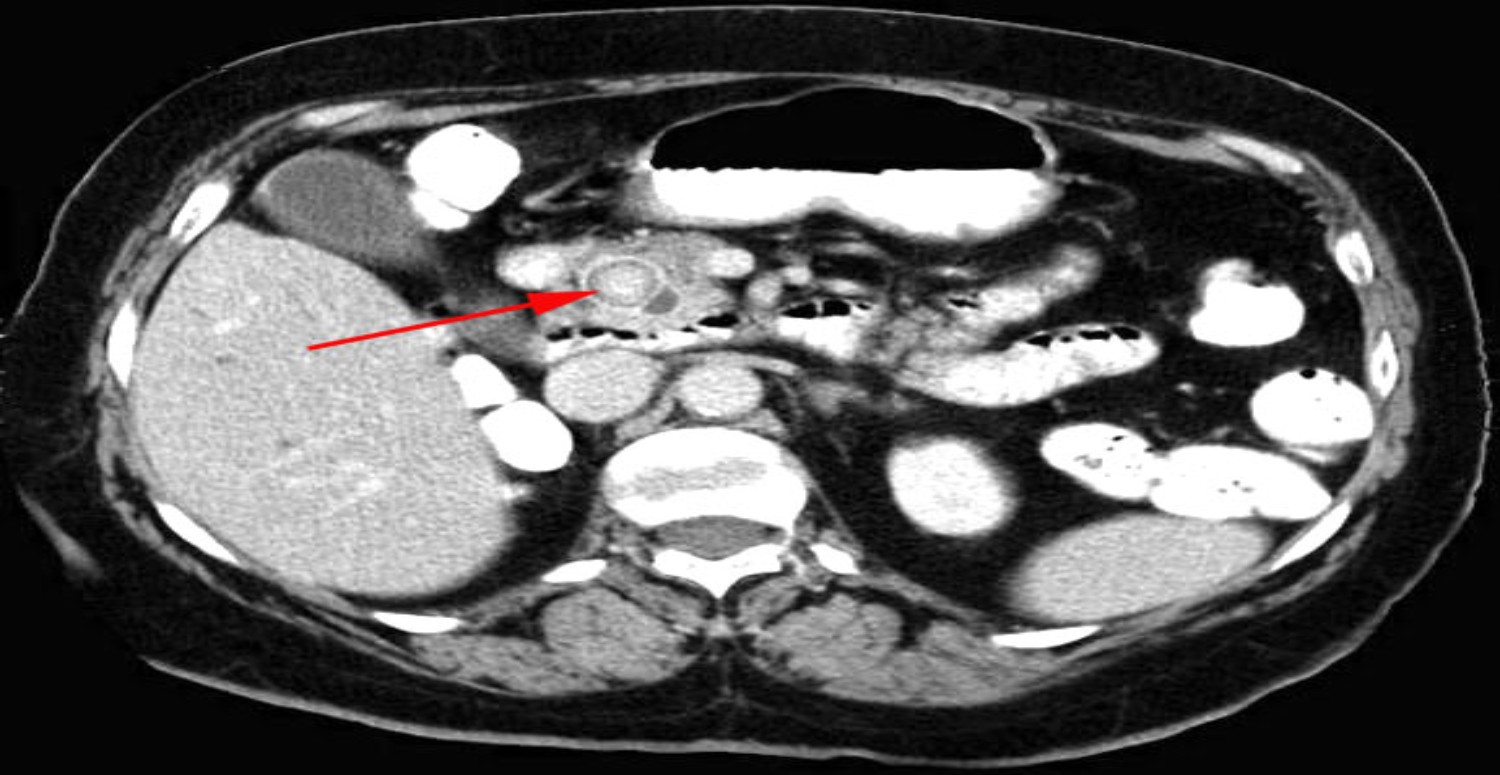 safra kesesi teşhisi