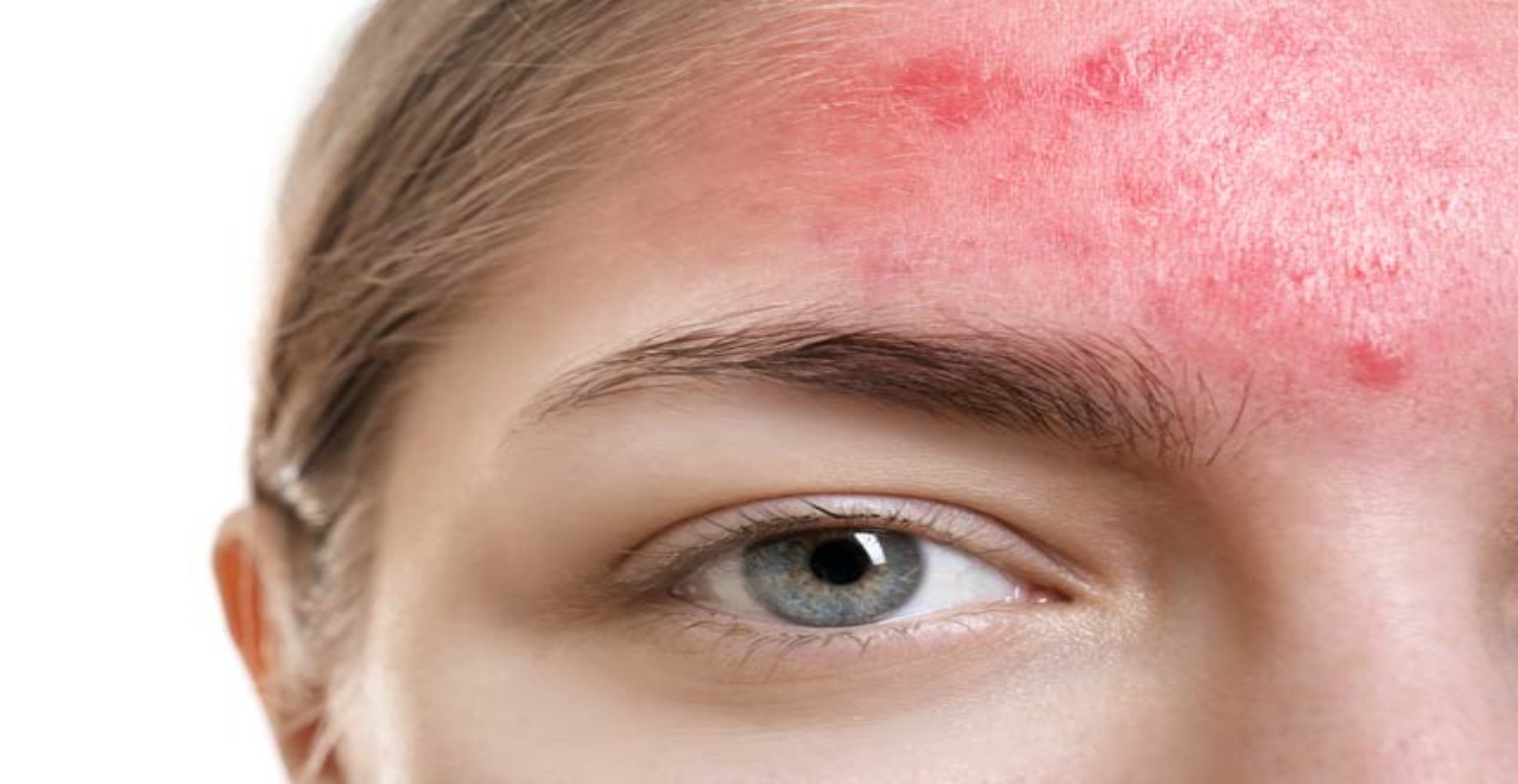 seboreik egzama belirtileri nelerdir