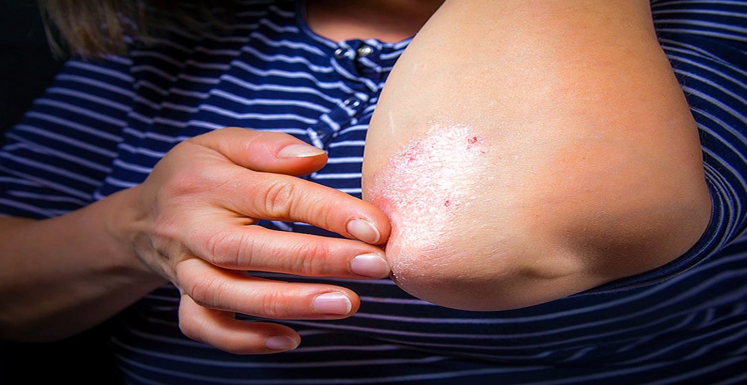 SEDEF HASTALIĞI HAKKINDA