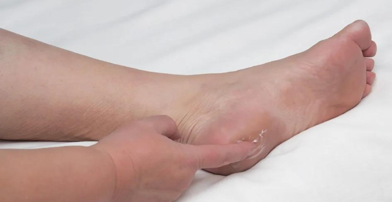 topuk dikenine ne iyi gelir