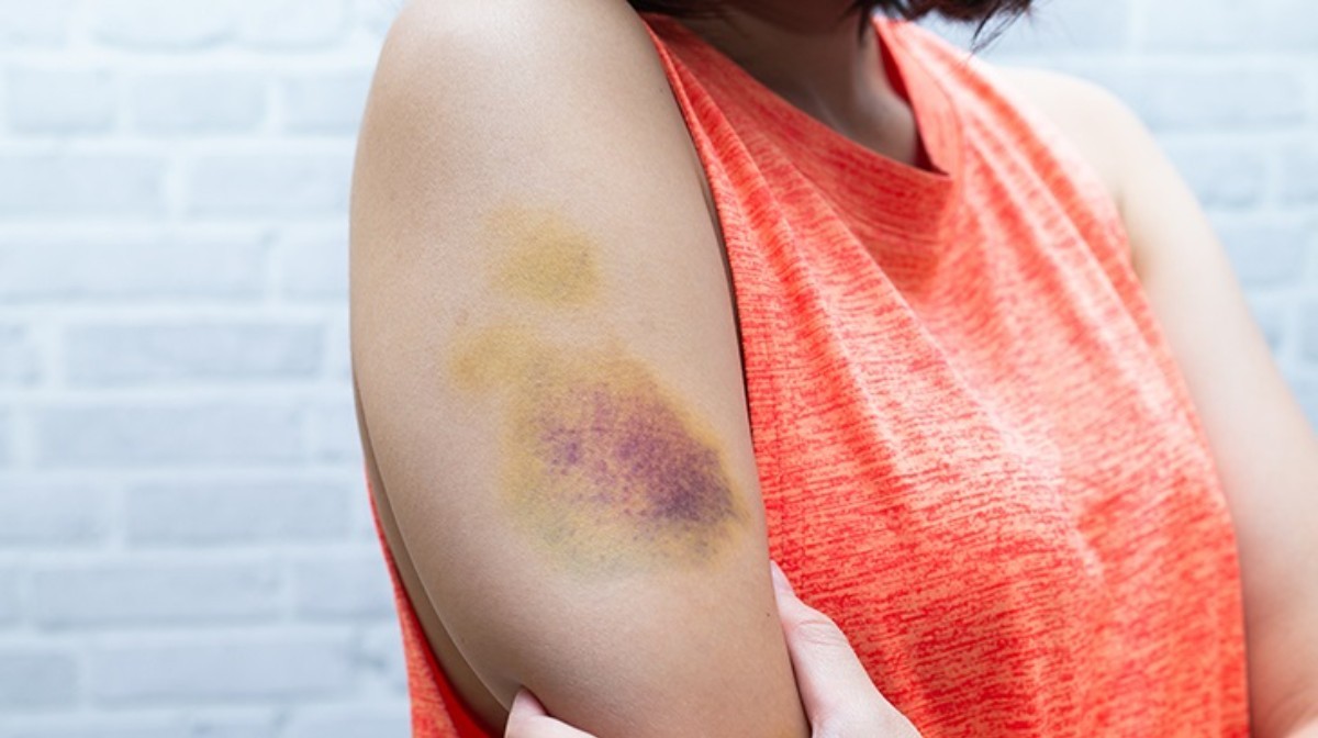 Vücudunuzda sık sık morluklar çıkıyorsa aman dikkat