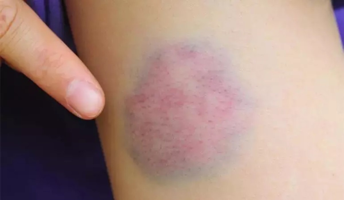 Vücudunuzda sık sık morluklar çıkıyorsa aman dikkat