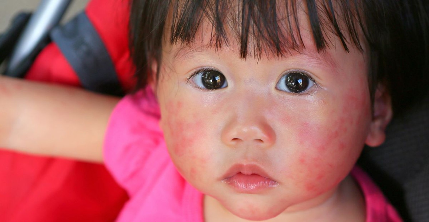 BEŞİNCİ HASTALIK HAKKINDA