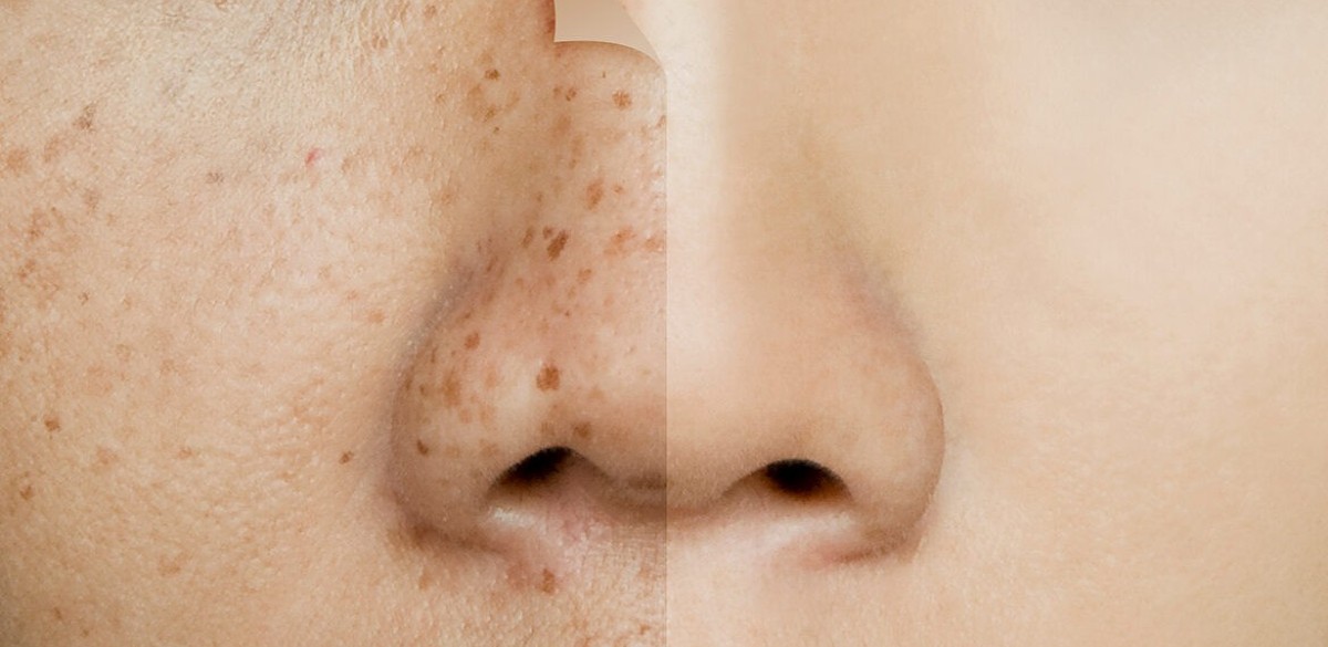 elma sirkesi cilde sürülür mü