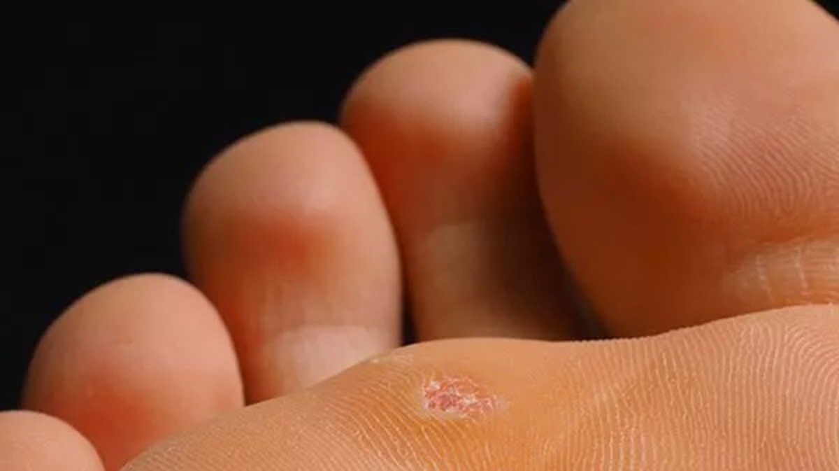 Ayak nasırları nasıl tedavi edilir