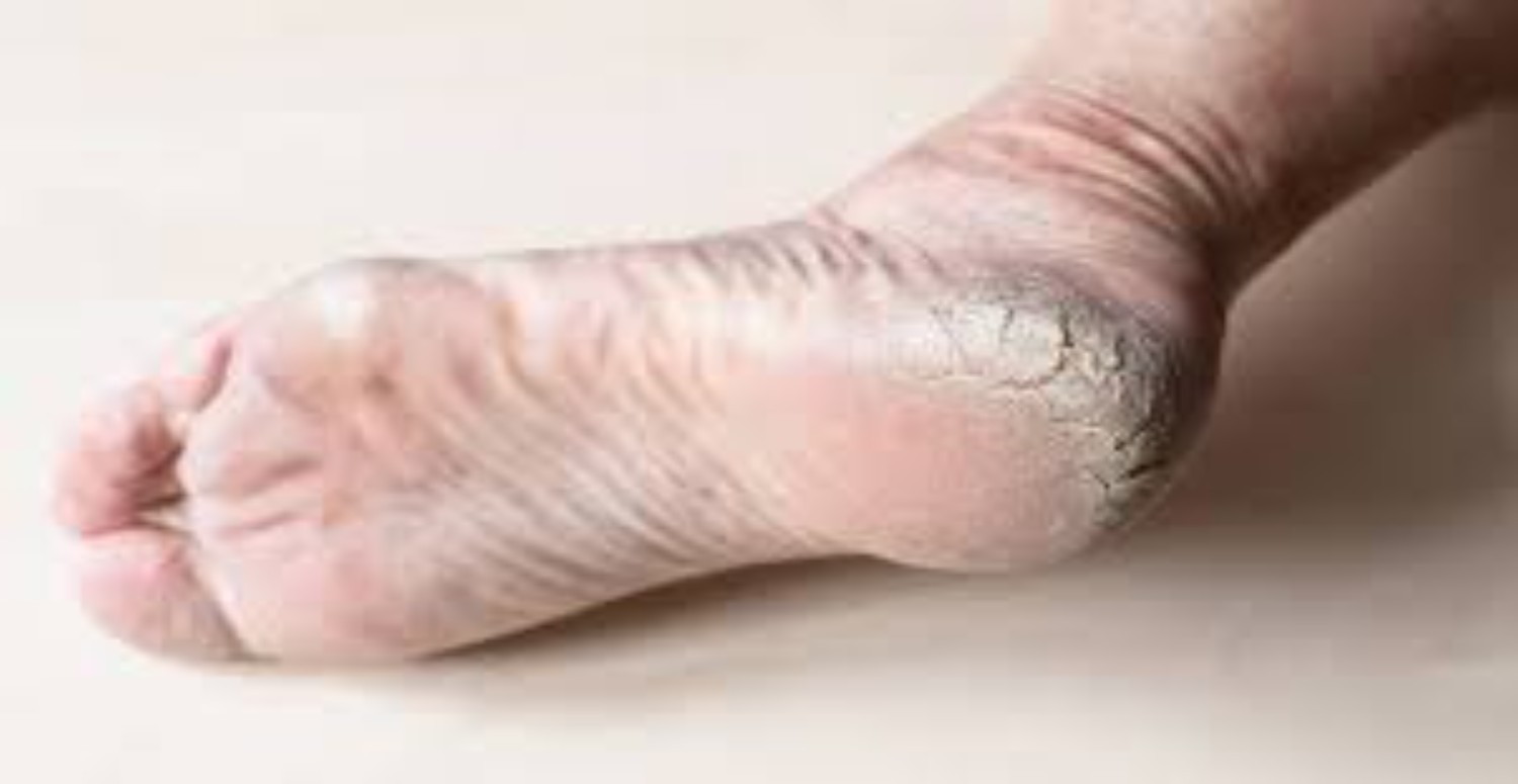 Topuk çatlaklarını silip süpürüyor! Tek karışımla pamuk gibi topuklara kavuşun