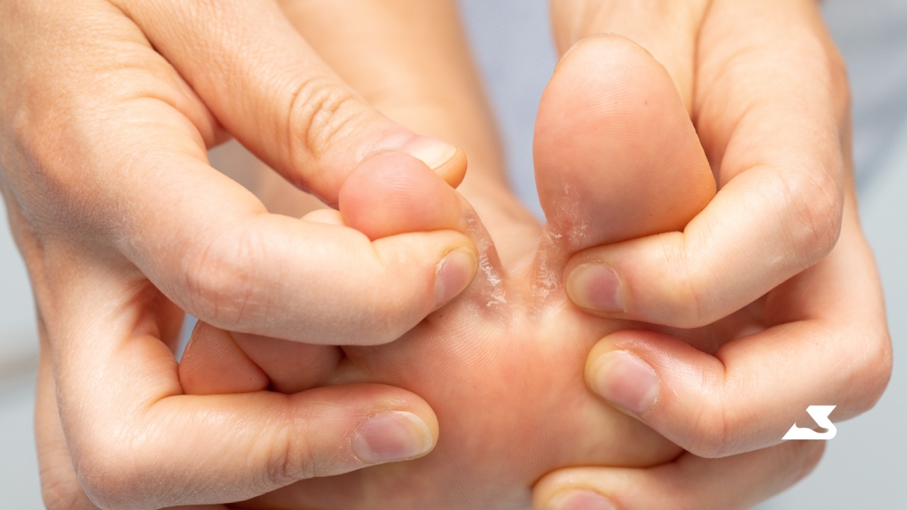  Mantar, Egzama ve Nasırı Yok Eden Doğal Çözüm: Ayakları Yumuşacık Yapıyor!