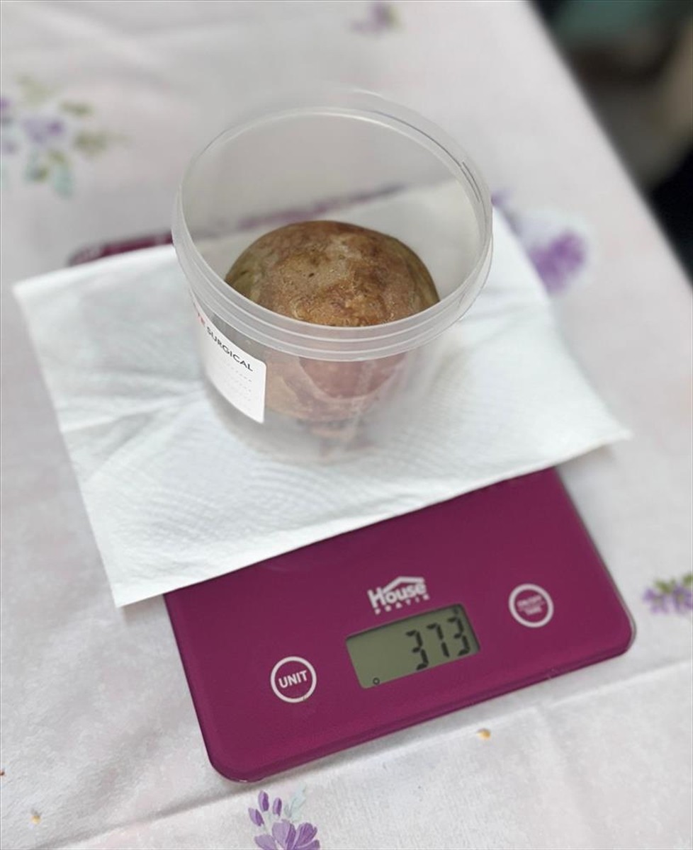 Giresun'da bir hastanın mesanesinden ameliyatla 10 santimetre çapında 370 gram ağırlığında taş...