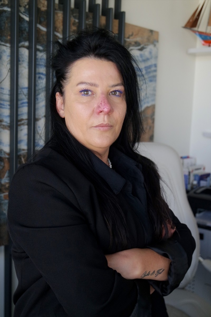 Bursa'da 2 yıl önce arkadaşının rottweiler cinsi köpeğinin saldırması sonucu yüzünde doku kaybı...