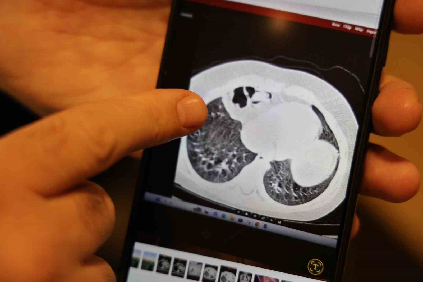 DİYARBAKIR’DA YAŞAYAN 2 YAŞINDAKİ TEVAB ARAM ZENGİN, DOĞUŞTAN BAĞIRSAKLARININ GÖĞÜS BOŞLUĞUNA...