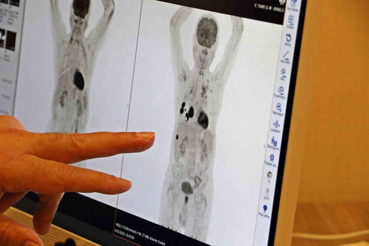 ONKOLOJİ BÖLÜMÜ'NDEN PROF. DR. ALİ MURAT TATLI, SON YILLARDA YAŞANAN TIBBİ GELİŞMELERLE BİRLİKTE...