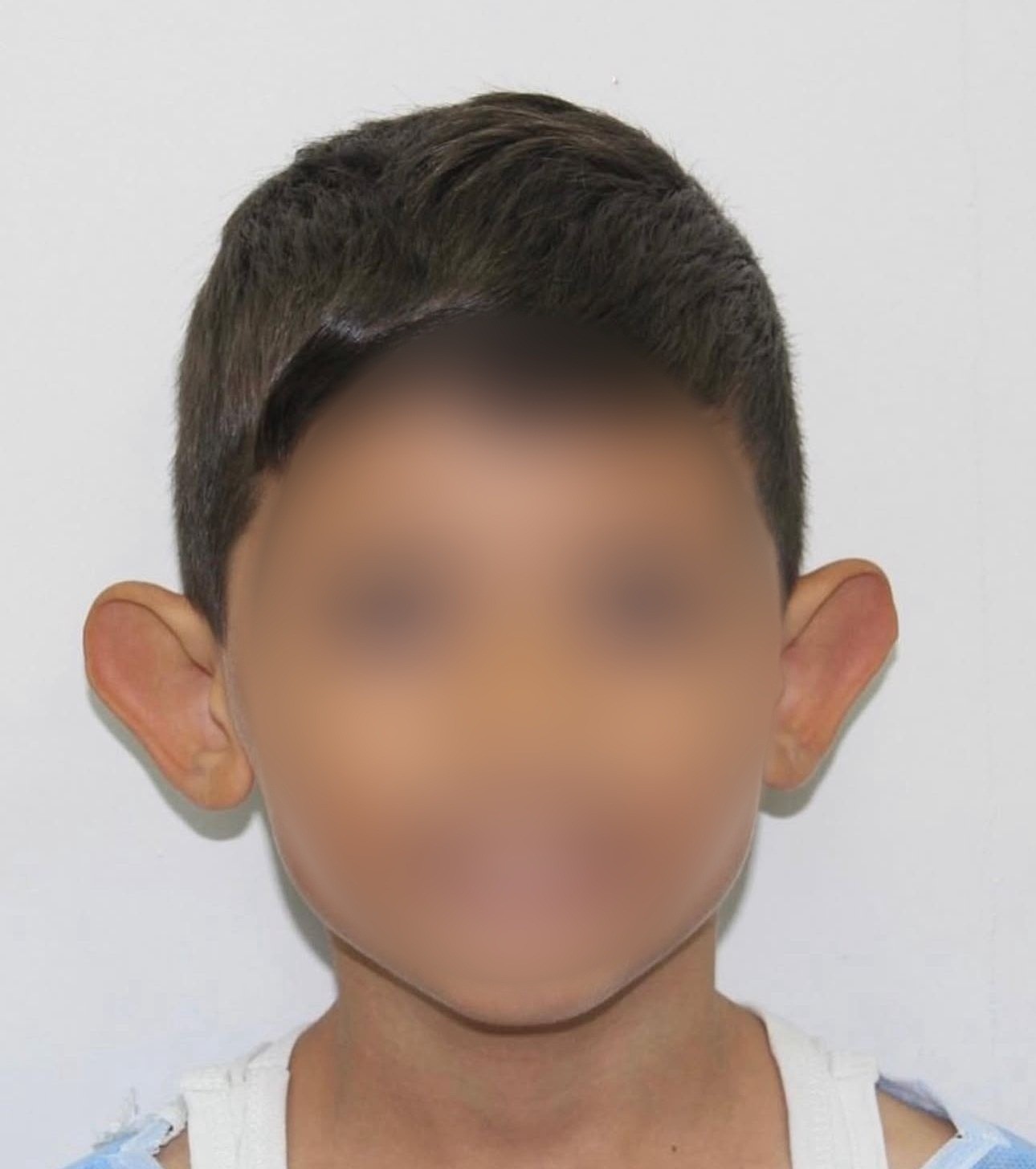 ÜNLÜ ESTETİK CERRAH PROF. DR. HAYATİ AKBAŞ, ÇOCUKLARDA DOĞUŞTAN GÖRÜLEN KULAK ŞEKİL...