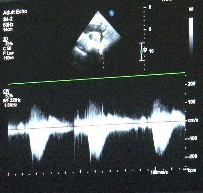 UZMANLARDAN DOĞUMSAL KALP HASTALIĞI AÇIKLAMASI: "ERKEN TANI MÜMKÜN"