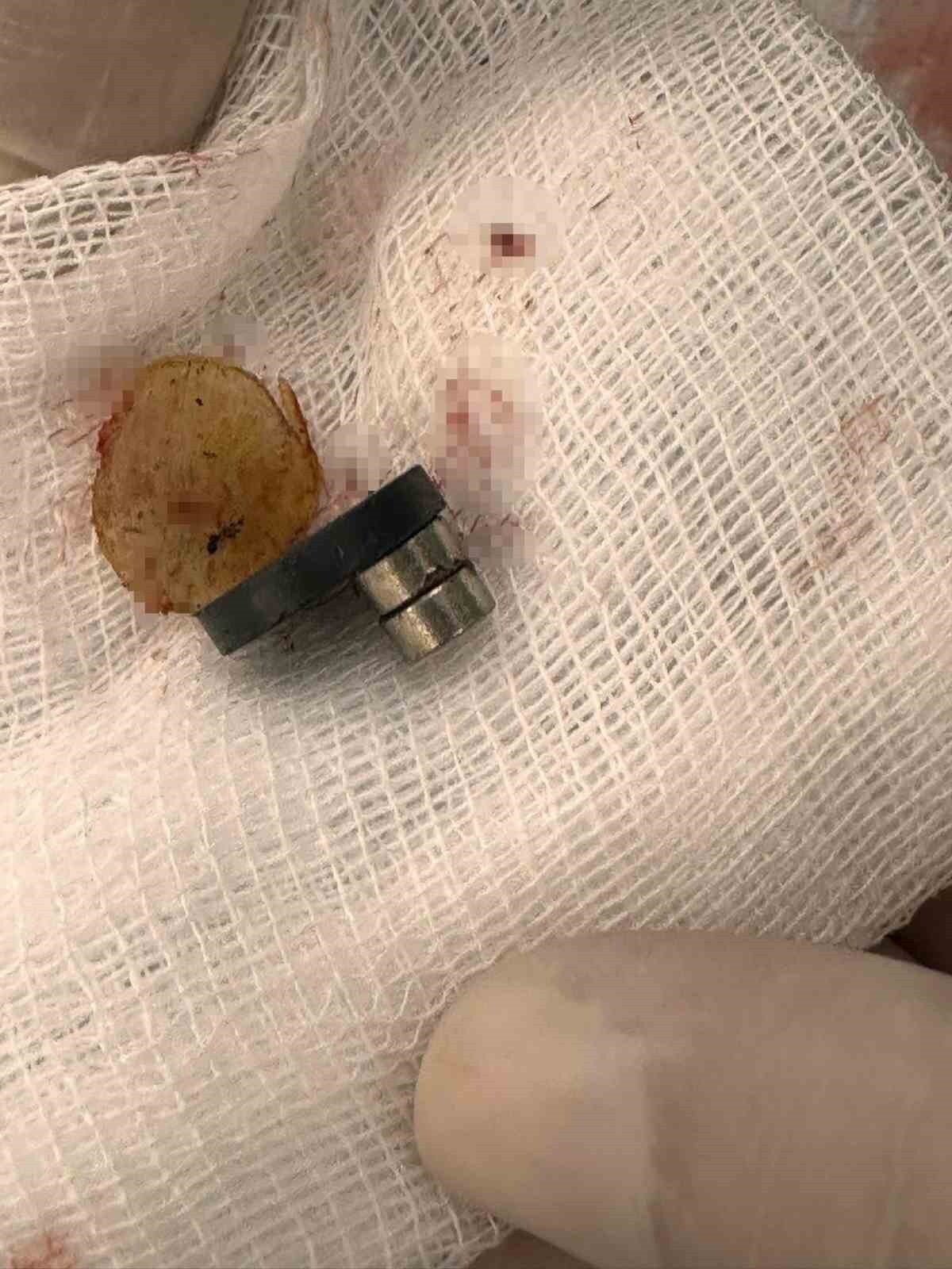 BATMAN EĞİTİM VE ARAŞTIRMA HASTANESİ’NE 3 ADET MIKNATIS YUTMA ŞİKÂYETİYLE GETİRİLEN 1,5 YAŞINDAKİ...