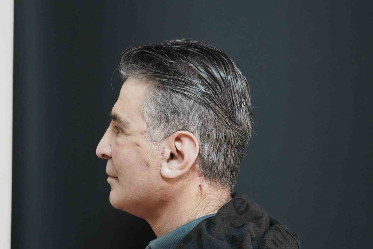 BİTLİS’TE SAĞLIK ALANINDA ÖNEMLİ BİR İLKE İMZA ATILARAK İLK KEZ DERİN PLAN (DEEP PLANE) YÜZ GERME...