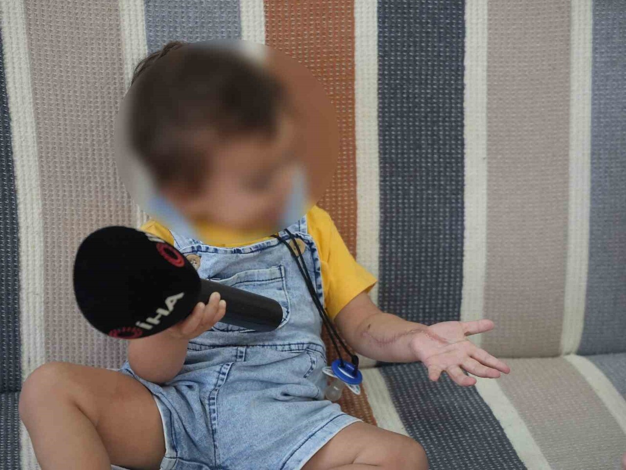 ÇOCUK İKİ AMELİYAT GEÇİRDİ VE KOLUNDA KALICI İZLER OLUŞTU