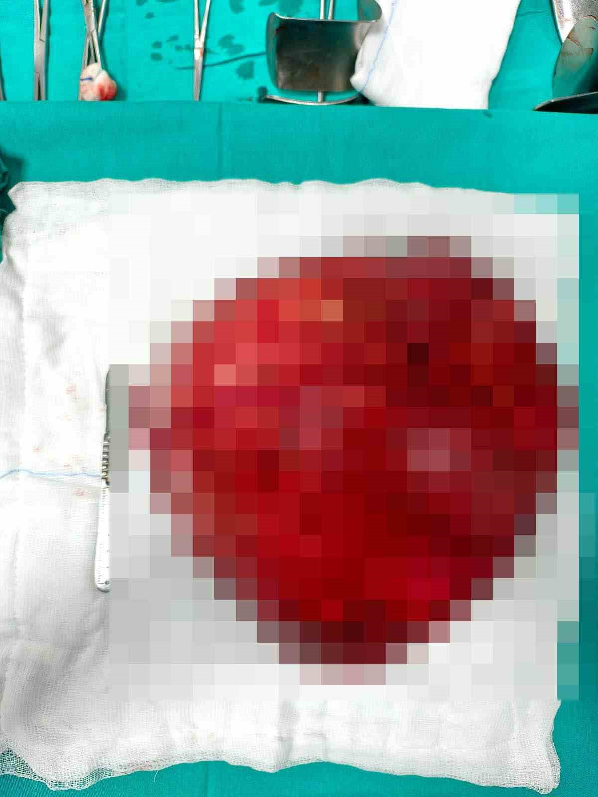 KONYA’NIN AKŞEHİR İLÇESİNDE GÖRME ENGELLİ BİR HASTANIN RAHMİNDEN KAYNAKLANAN VE KARIN BOŞLUĞUNU...