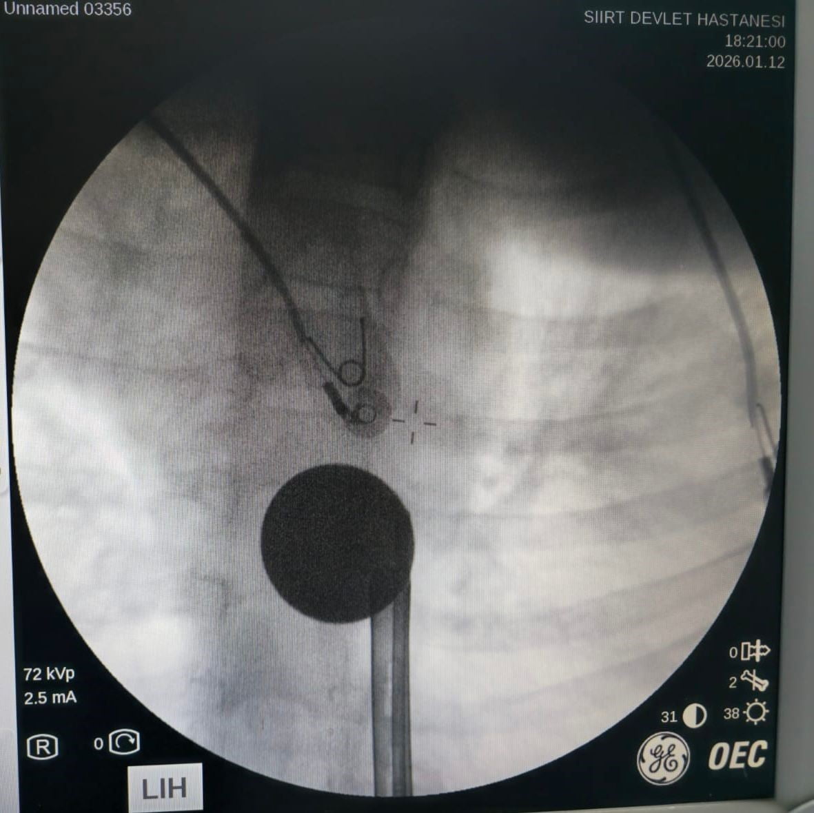 SİİRT'TE BOĞAZINA MADENİ 5 LİRA KAÇAN 8 YAŞINDAKİ ÇOCUK, HASTANEDE DOKTOR MÜDAHALESİYLE...