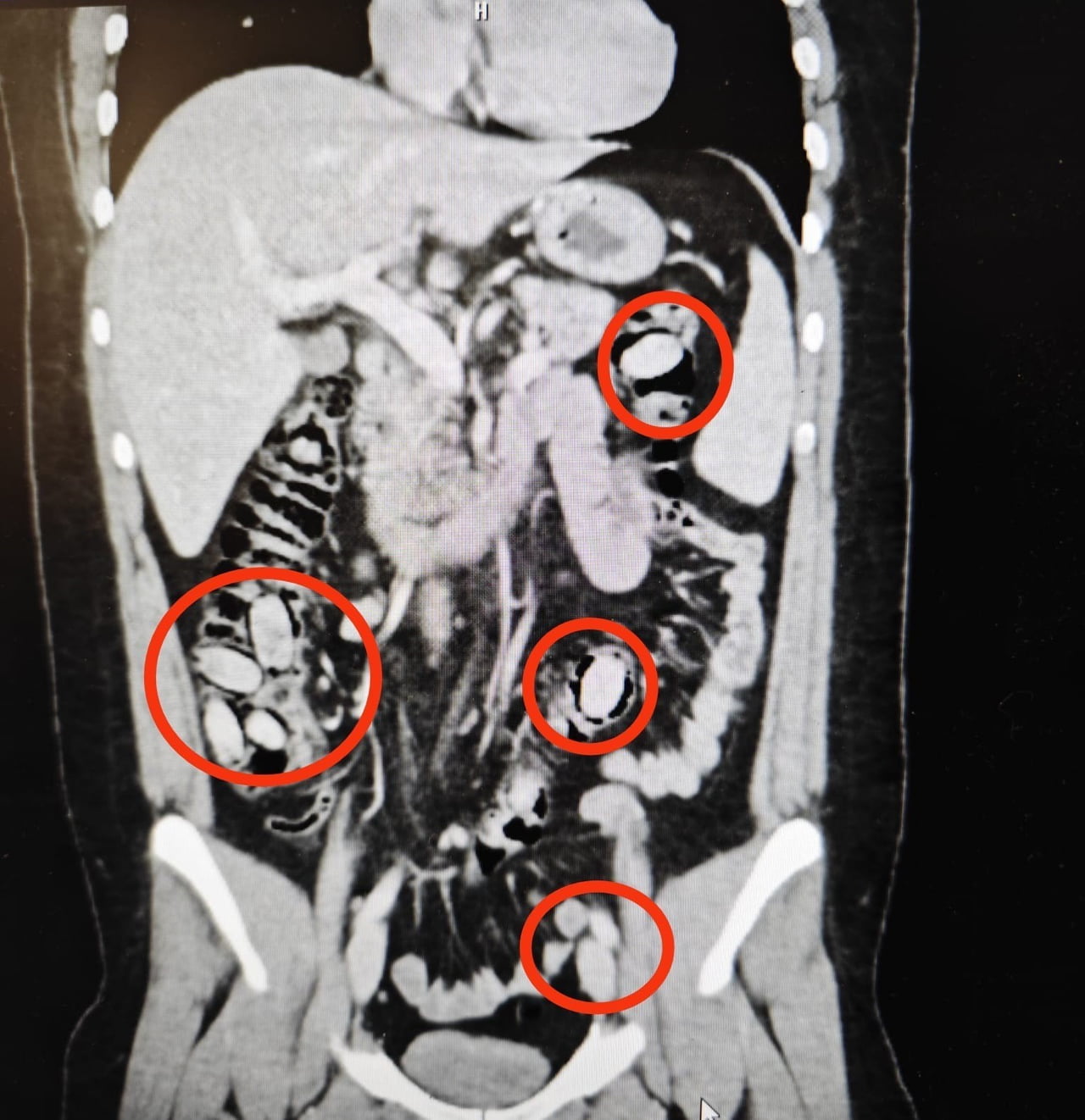 YURTDIŞINDAN ESKİŞEHİR’E 44 KAPSÜL UYUŞTURUCU MADDEYİ MİDESİNDE SOKMAYA ÇALIŞAN YABANCI UYRUKLU...