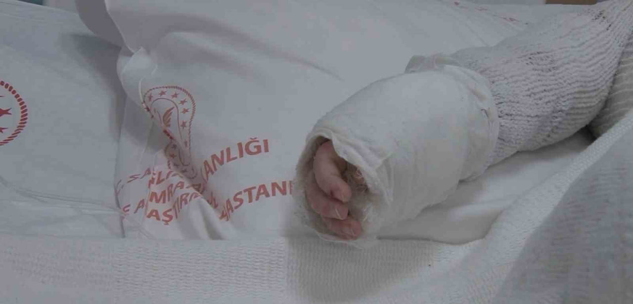 ÜZERİNE KAYNAR SU DÖKÜLEN BEBEĞİN VÜCUDUNUN YÜZDE 27’Sİ YANDI